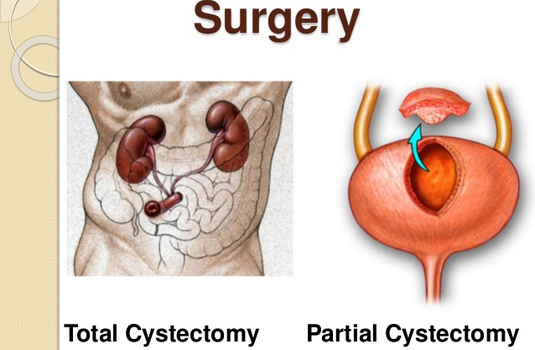 Partial Radical Cystectomy Surgery In India Cost Hospitals And Doctor